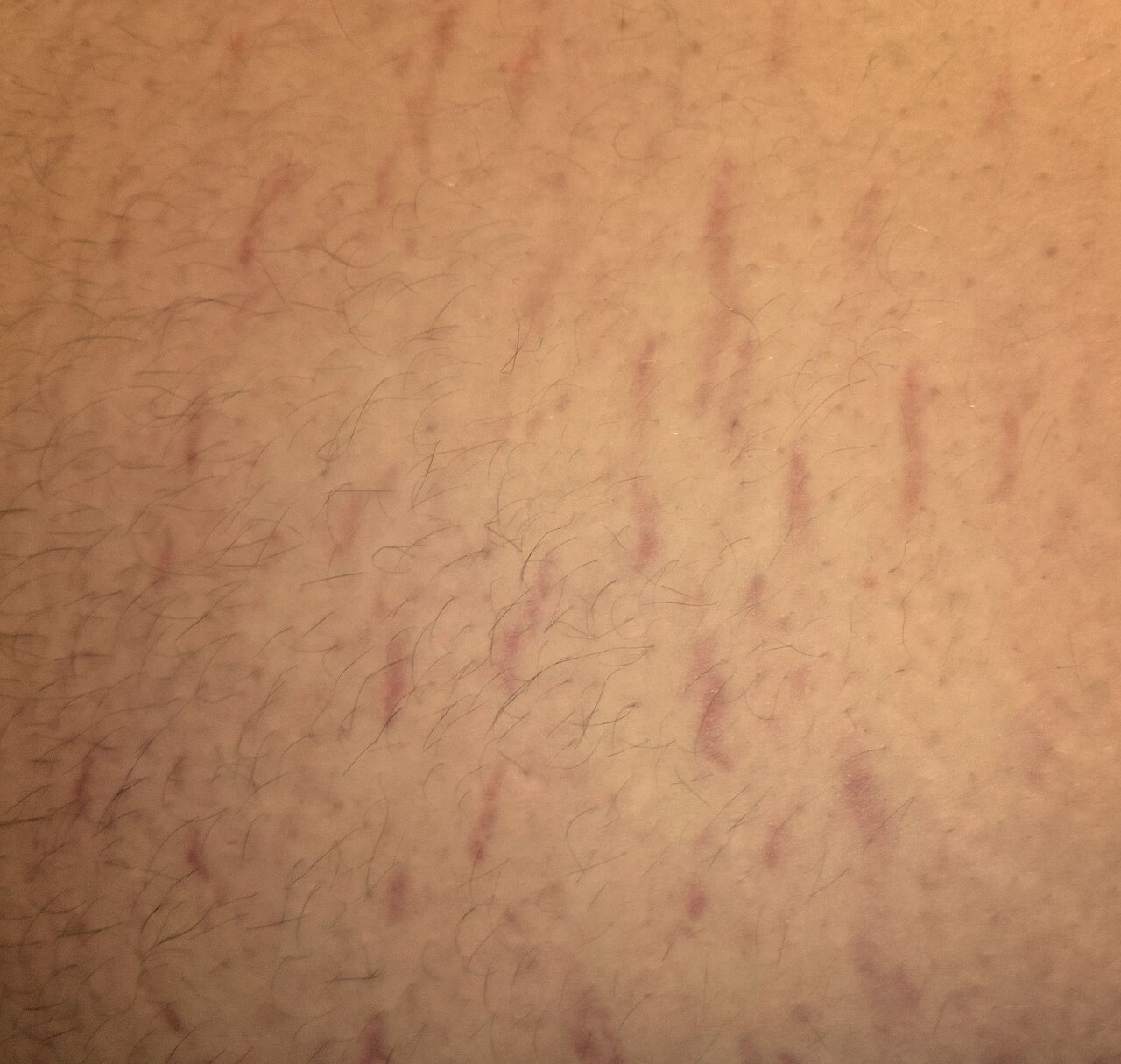 Stretchmarks on the abdomen of an obese adult male.