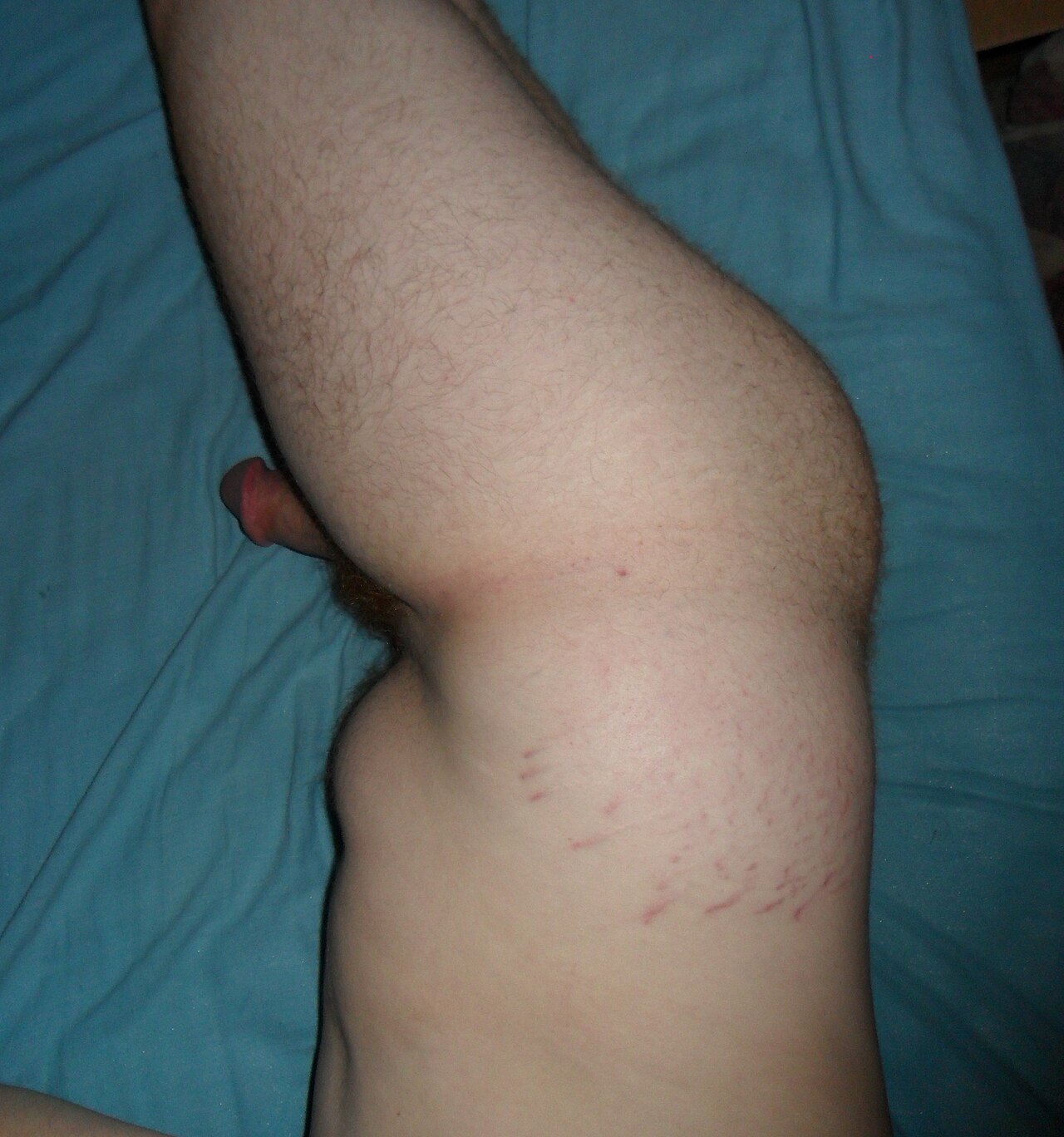 Stretch marks on an eighteen-year-old male's hip
