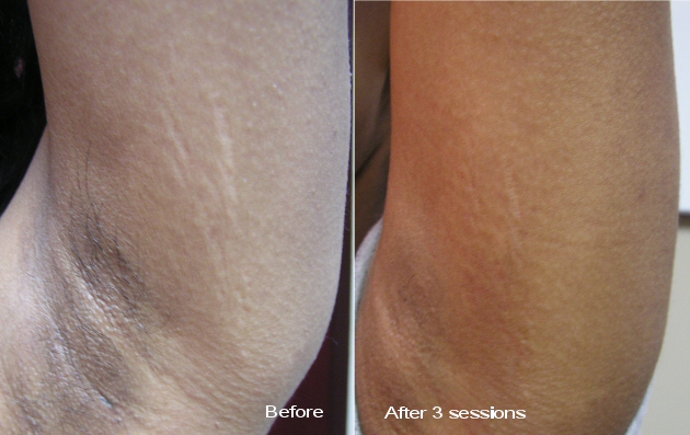 Stretch marks before and after 3 procedures