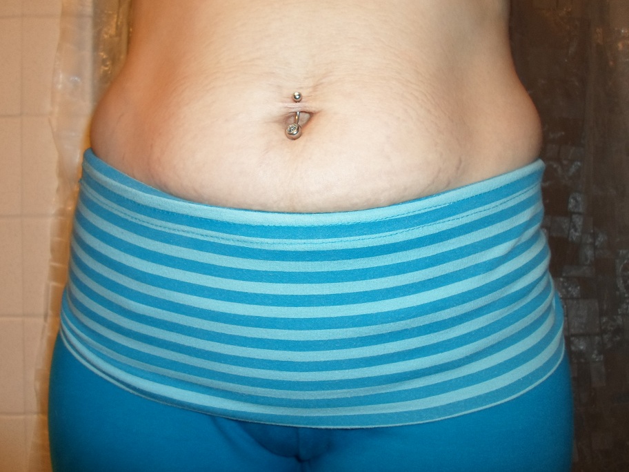 Female Torso with Tiger Stripes (Stretch Marks) from Pregnancy