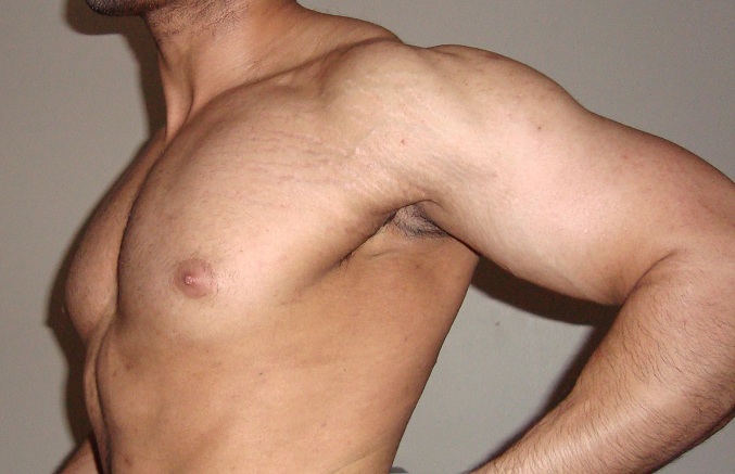 stretch marks on chest/shoulders of a male