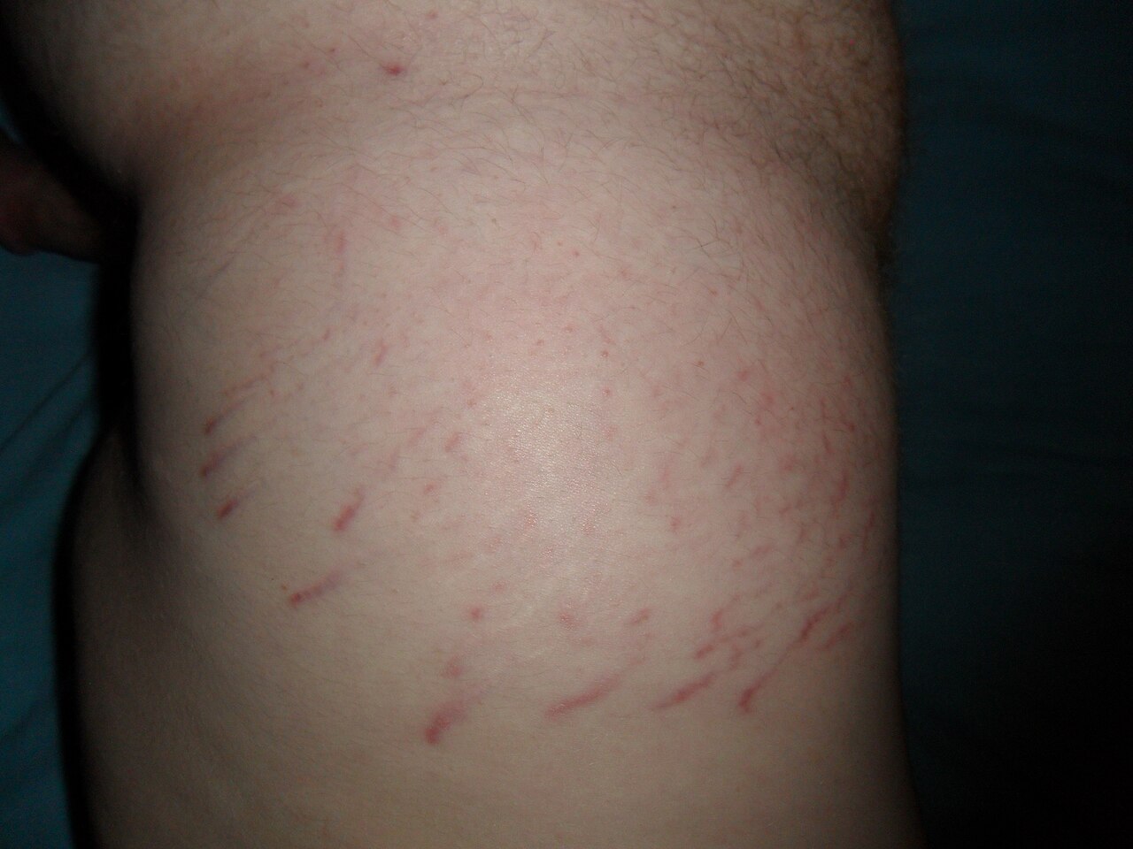 Stretch marks on an eighteen-year-old male's hip