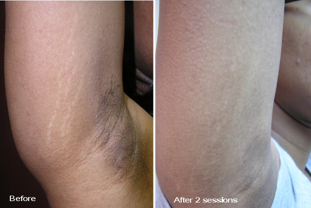 Stretch marks before and after 2 procedures