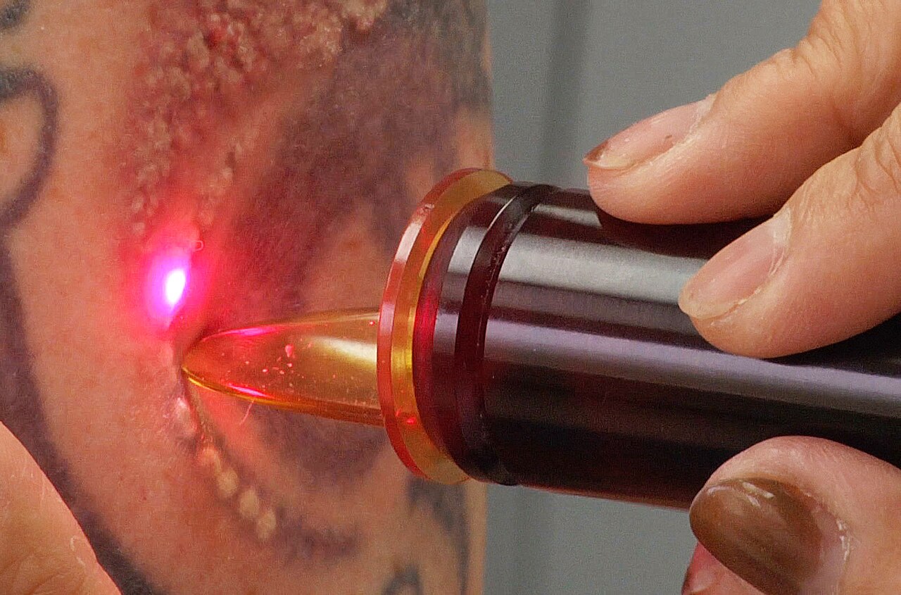 Laser Tattoo removal performed by Alice S. Pien MD, Medical Director of AMA Skincare