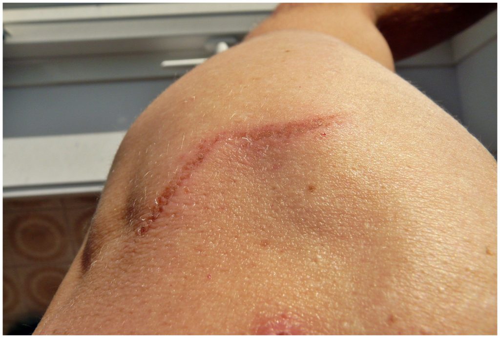scarring from laser tattoo removal