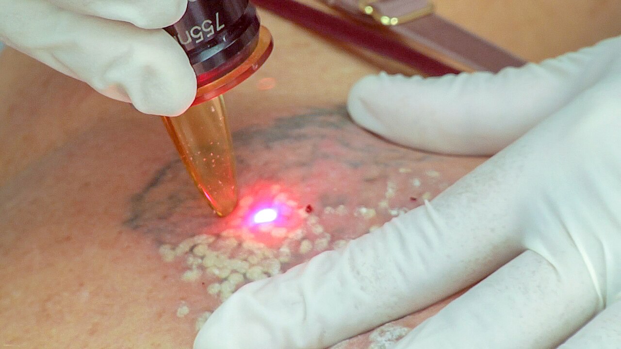Laser tattoo removal on female using Q-switch laser