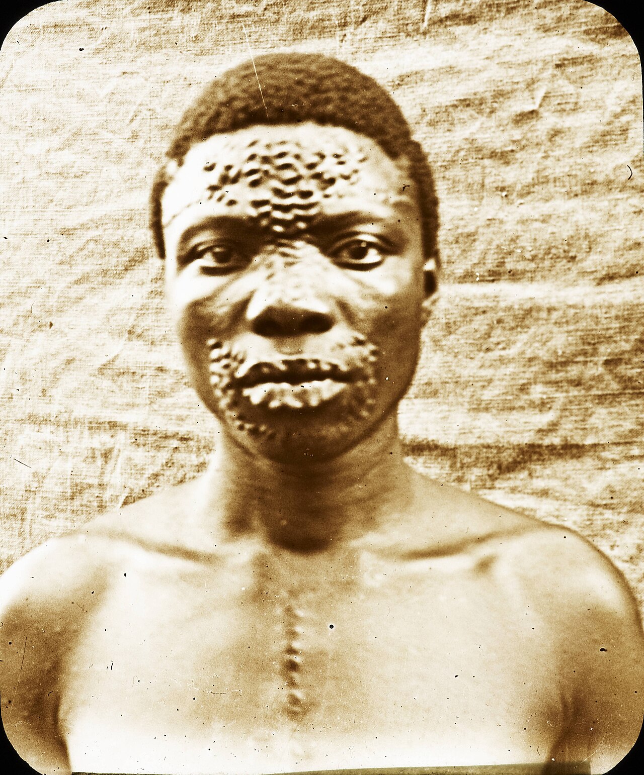 Man with scarification patterns, Congo, ca. 1900-1915Black and white lantern slide showing a man with scarification designs on his chest, face and lips, in Belgian colonial Congo Free State or post-1