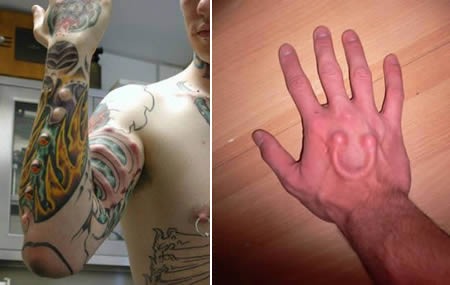 Subdermal implant (Body modification)