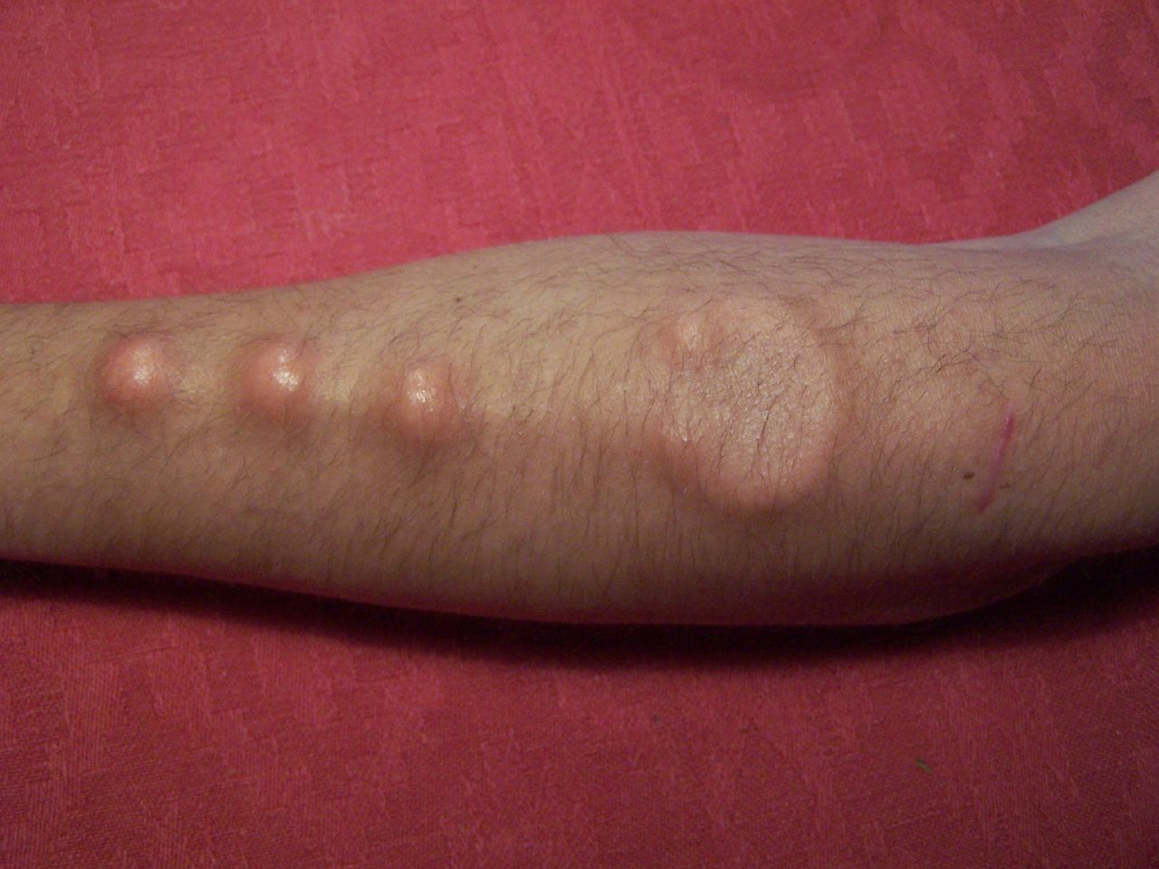 A friend's implants. Some weeks later the ball in the middle started to wander downwards and is a lot closer to the left one in the picture now. Sucks cause you can't just push it back it place, you k