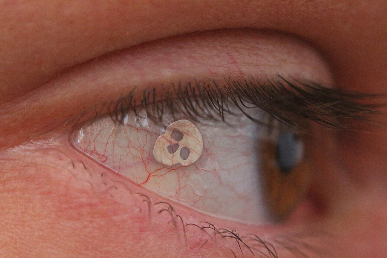 Heald Skull Eyeball Implant. Made by Danny - Rock the Body - Switzerland