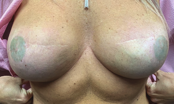 A woman's breasts, the nipples and areolas of which have been recreated in two dimensions using surface abrasion, prior to receiving a second, three-dimensional tattoo