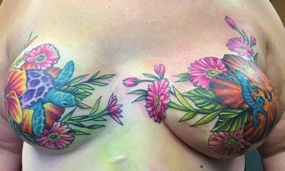 The reconstructed breasts of a woman after mastectomy, the absence of nipples and areolas obscured by decorative medical tattoos