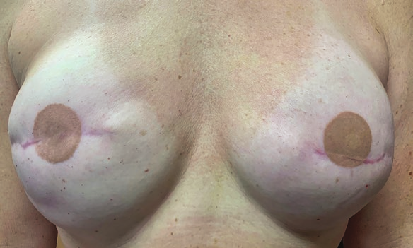 A woman's breasts, the nipples and areolas of which have been recreated in two dimensions using surface abrasion, prior to receiving a second, three-dimensional tattoo