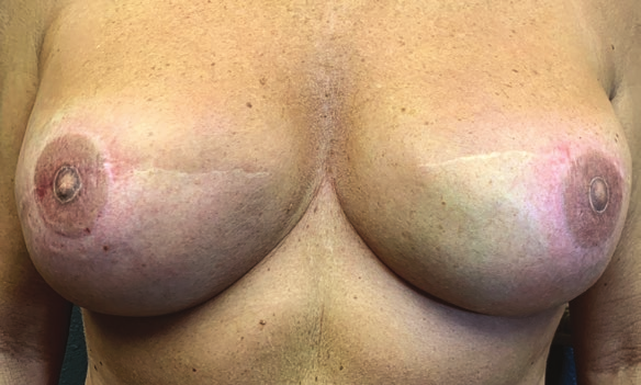 A woman's breasts, the nipples and areolas of which have been recreated by medical tattoo, a new three-dimensional tattoo replacing a previous two-dimensional one