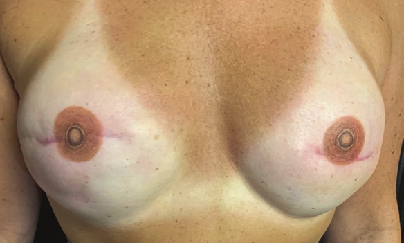 A woman's breasts, the nipples and areolas of which have been recreated by medical tattoo, a new three-dimensional dermal-penetration tattoo replacing a previous two-dimensional surface-abrasion one
