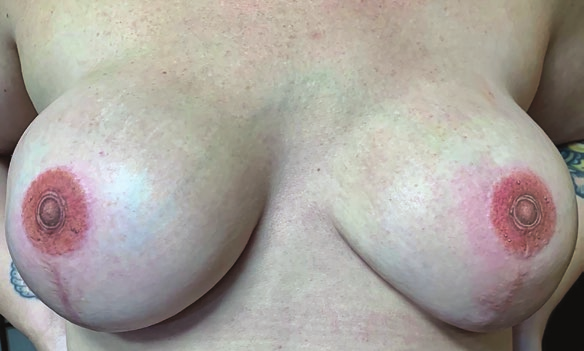 A woman's breasts, the nipples and areolas of which have been recreated by three-dimensional medical tattoo