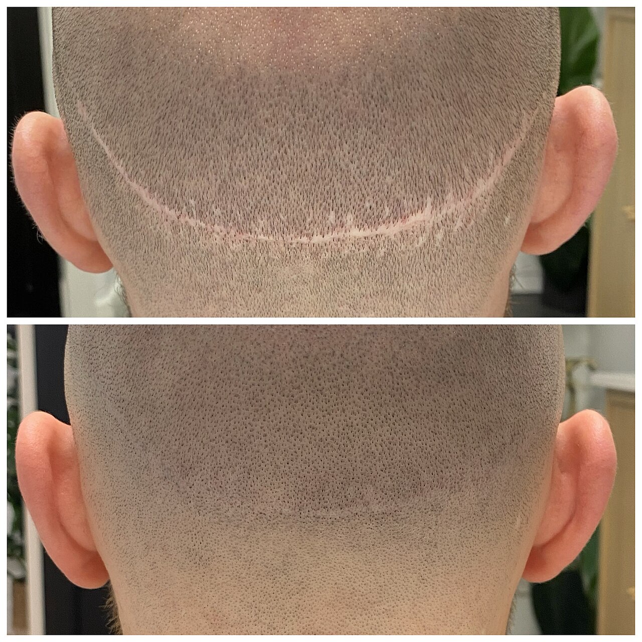 A hair tattoo has been used to help camouflage a FUT Hair Transplant scar which left the client feeling self conscious. The SMP or hair tattoo have blended out the scar sucessfully to allow the client