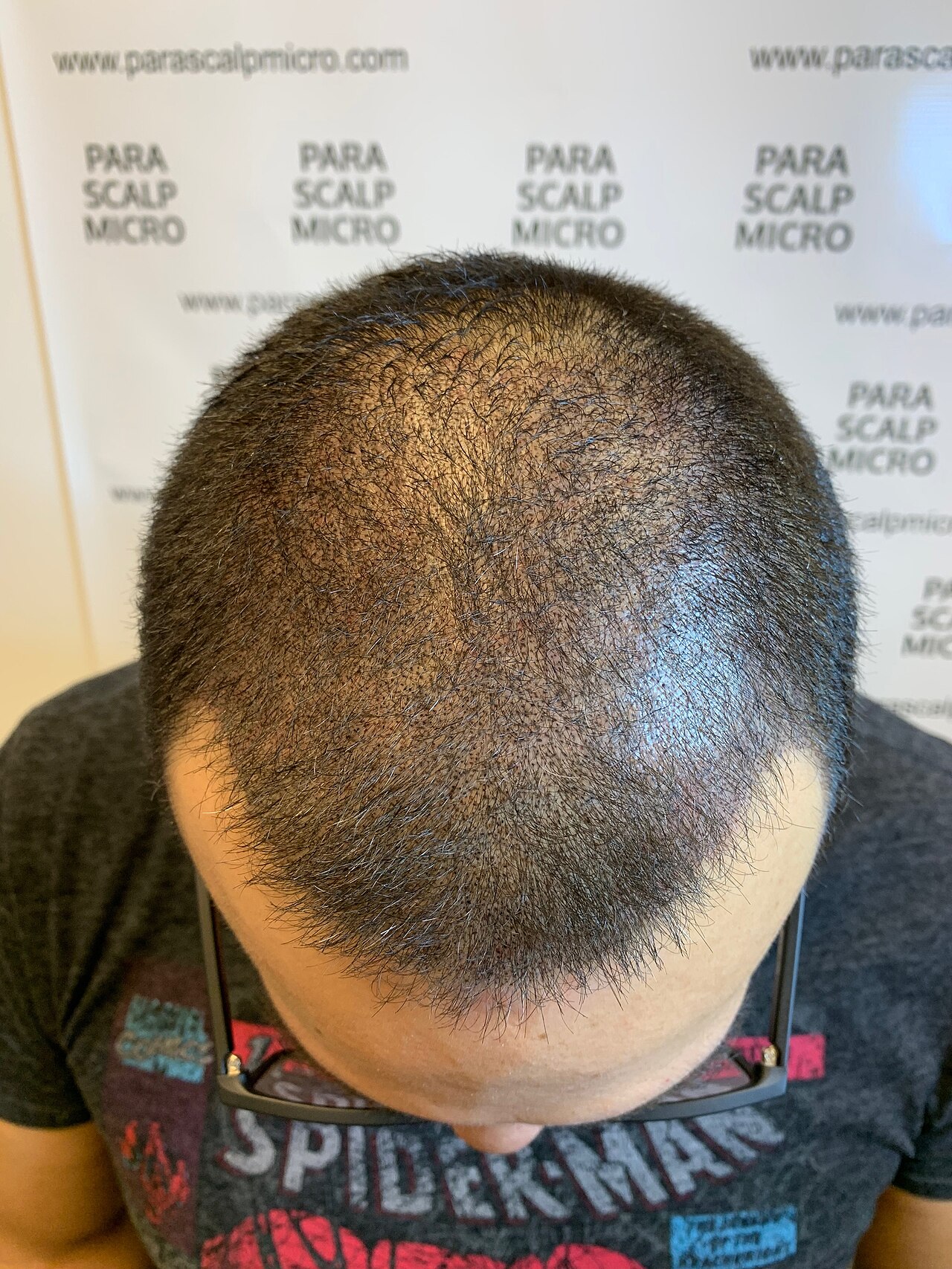 Scalp Micropigementation, Hair stimulation Hair Follicle Tattoo done by Parascalpmicro Institute adding Density to Hairline & Crown to fix Alopecia