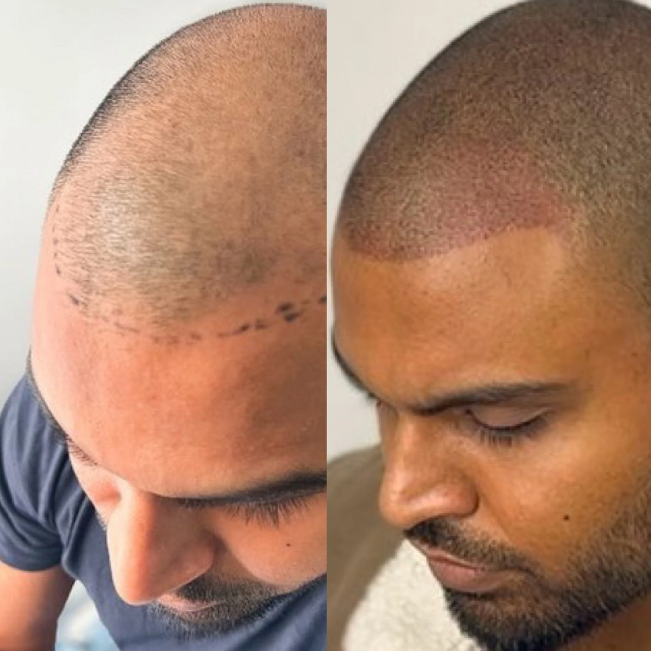 before and after scalp micropigmentation (smp) also known as a hair tattoo. lee stafford at smp london