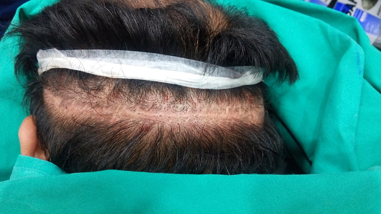 Area selected for micro pigmentation. Scar line is obvious on back of the head.