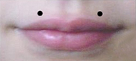 Position of the type of labret piercings known as "angel bites"