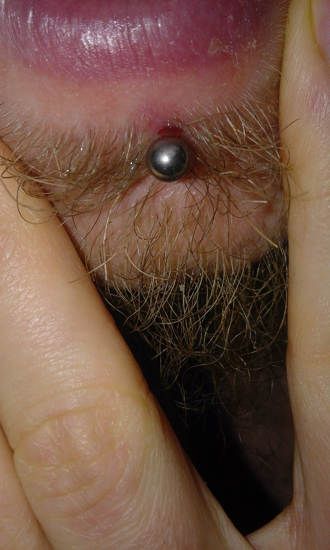 Hypertrophic scar (red spot) that developed on the lip 7 weeks after piercing it. Direct cause unknown. Picture taken 3 days after the scar was first noticed.