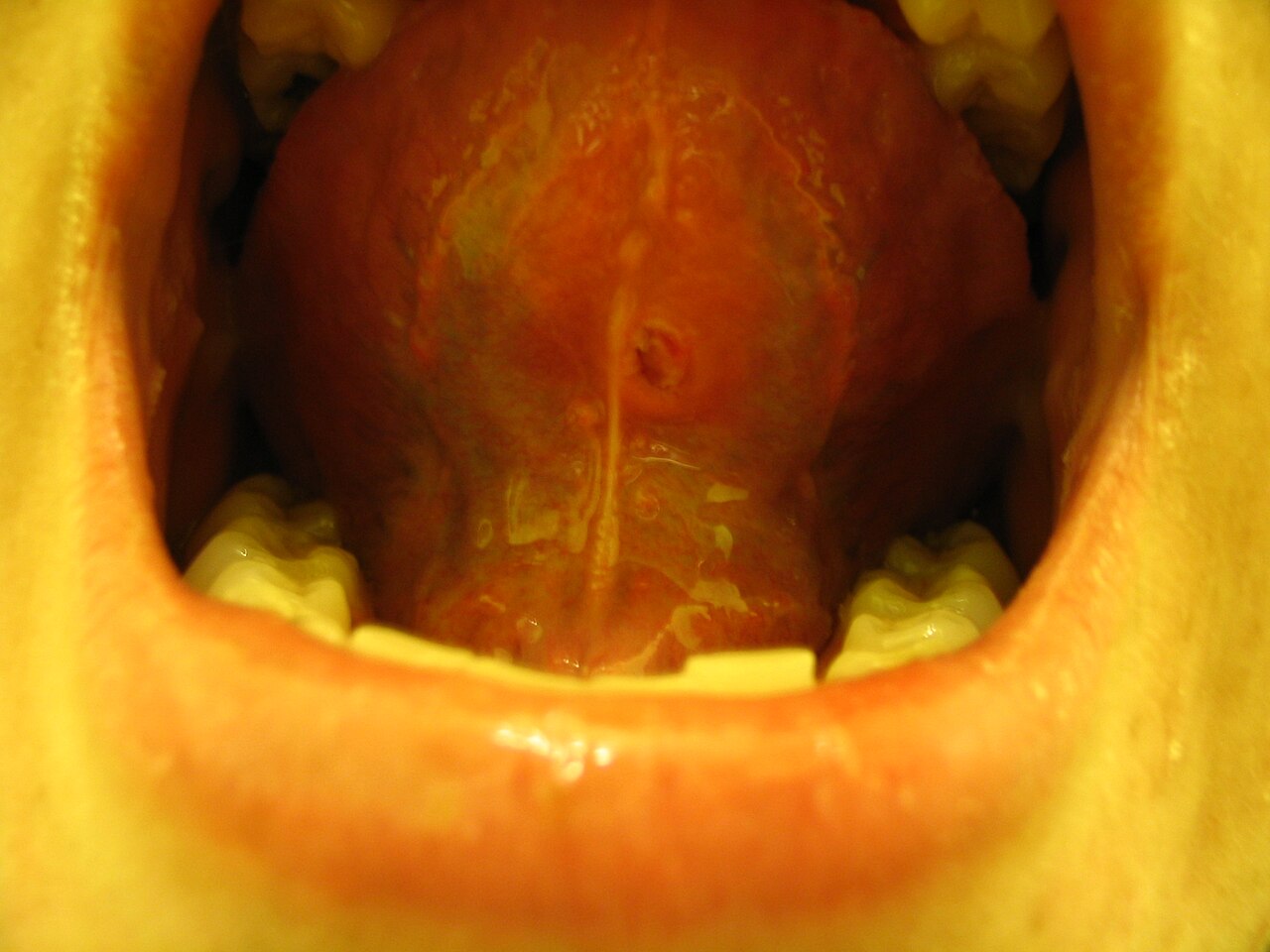 Scar of a tongue piercing on the bottom part of the tongue