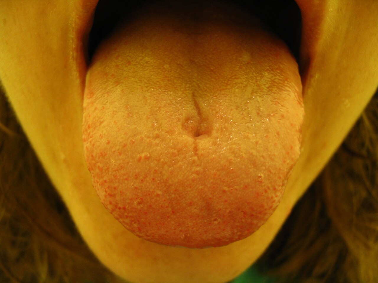 Scar of a tongue piercing on the upper part of the tongue