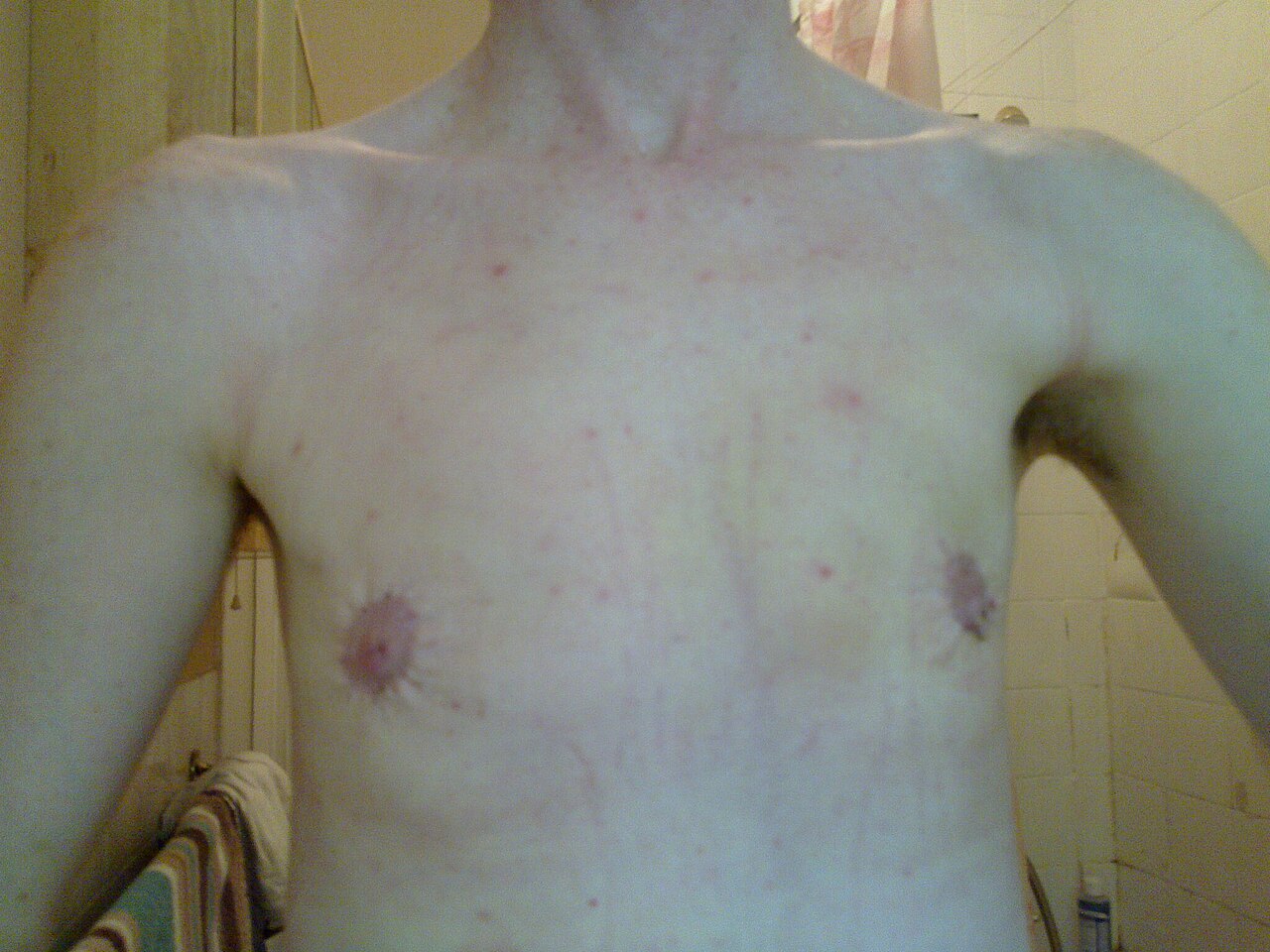 Most of the necrotic bit has come off. I was thinking it was actually really small at the end and so I didn't lose much, but then I looked at my first pictures and realised that my areola on the left