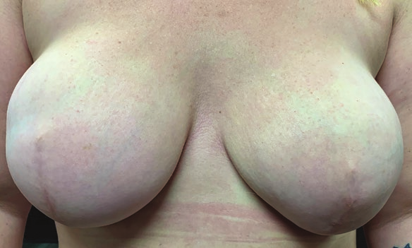 The reconstructed breasts of a woman after mastectomy, prior to receiving a medical tattoo.