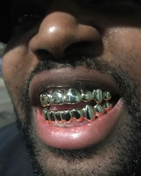 The top 8-teeth and the bottom 10-teeth are covered with 14k gold caps.