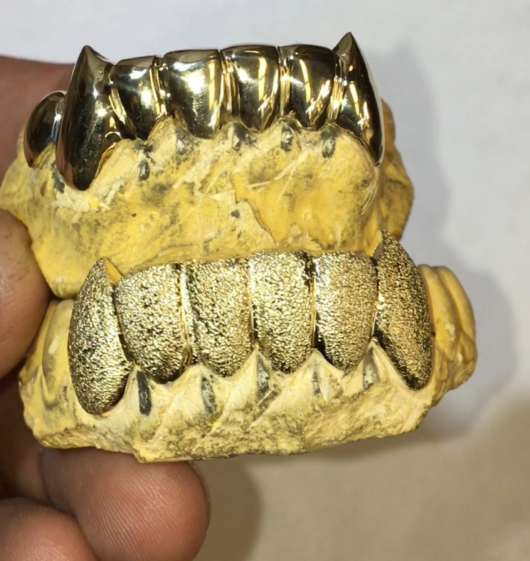 Two bottom teeth styles of grillz; top is clean gold and the bottom is diamond dust.