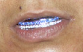 Dental grills